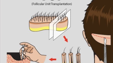 آنچه باید در مورد کاشت مو فولیکولی (FUT) بدانید