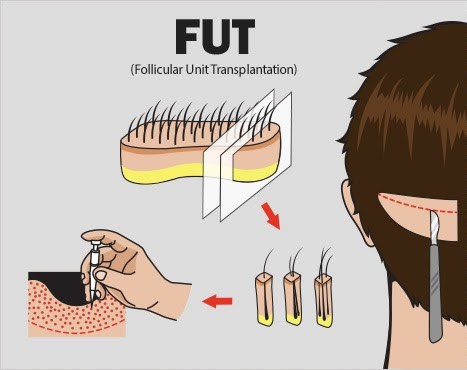 آنچه باید در مورد کاشت مو فولیکولی (FUT) بدانید